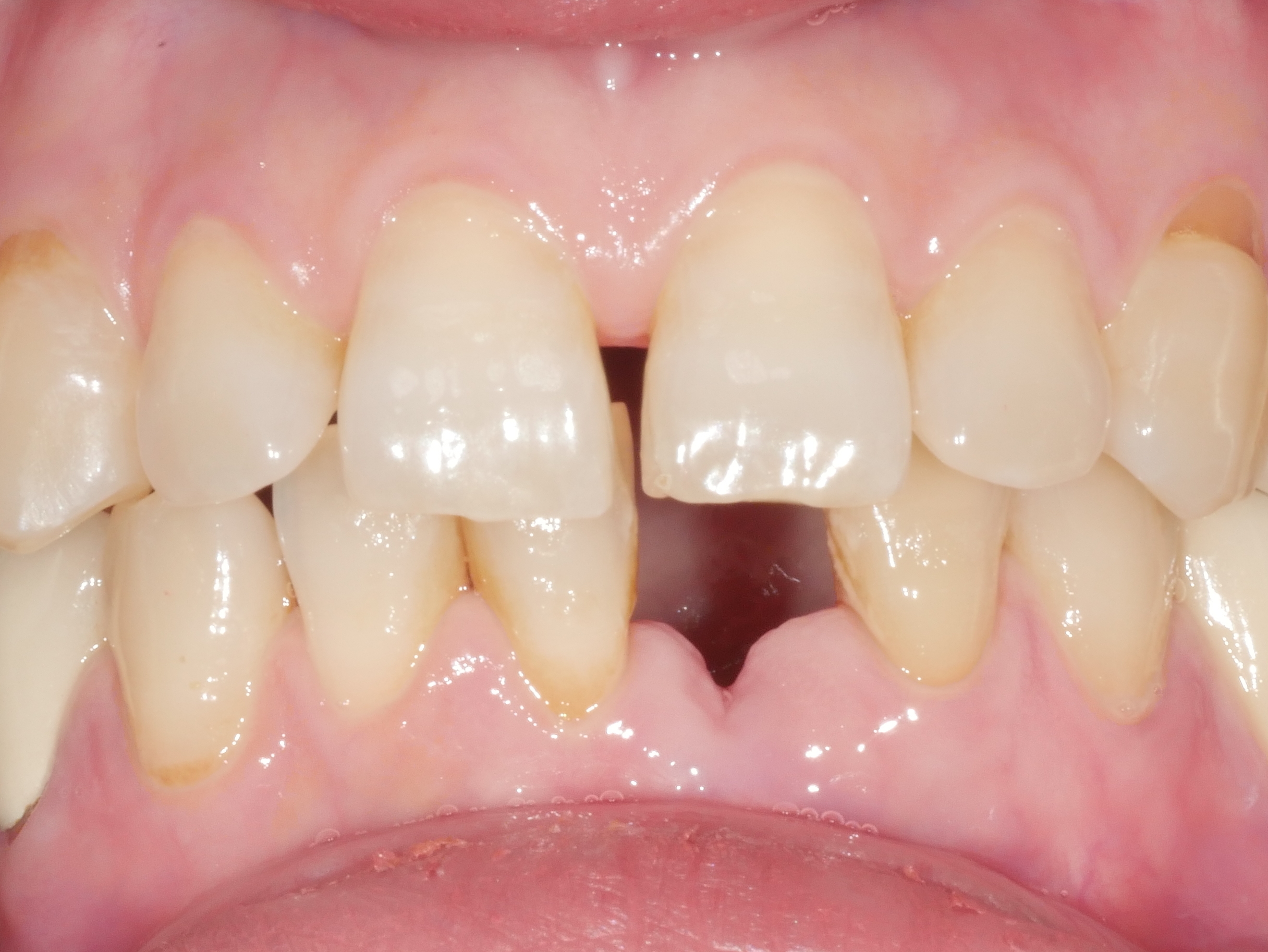 아래 앞니 임플란트