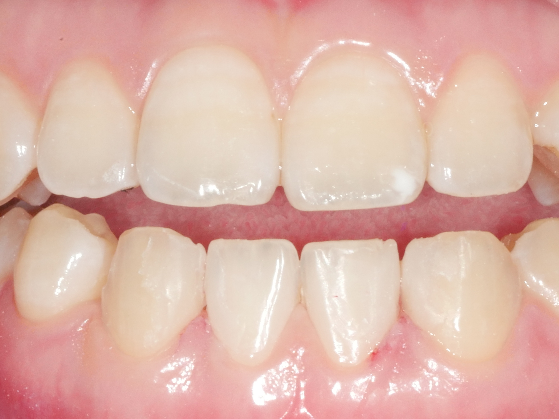 아래 앞니 치아 벌어짐 치료