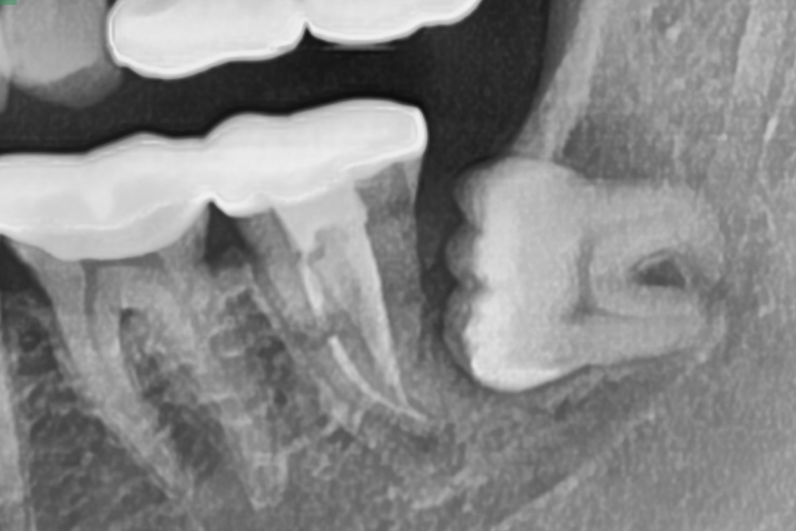 사랑니발치, 임플란트