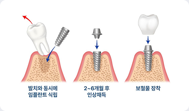 발치즉시 임플란트