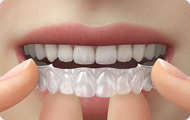 스케일링,  잇몸치료